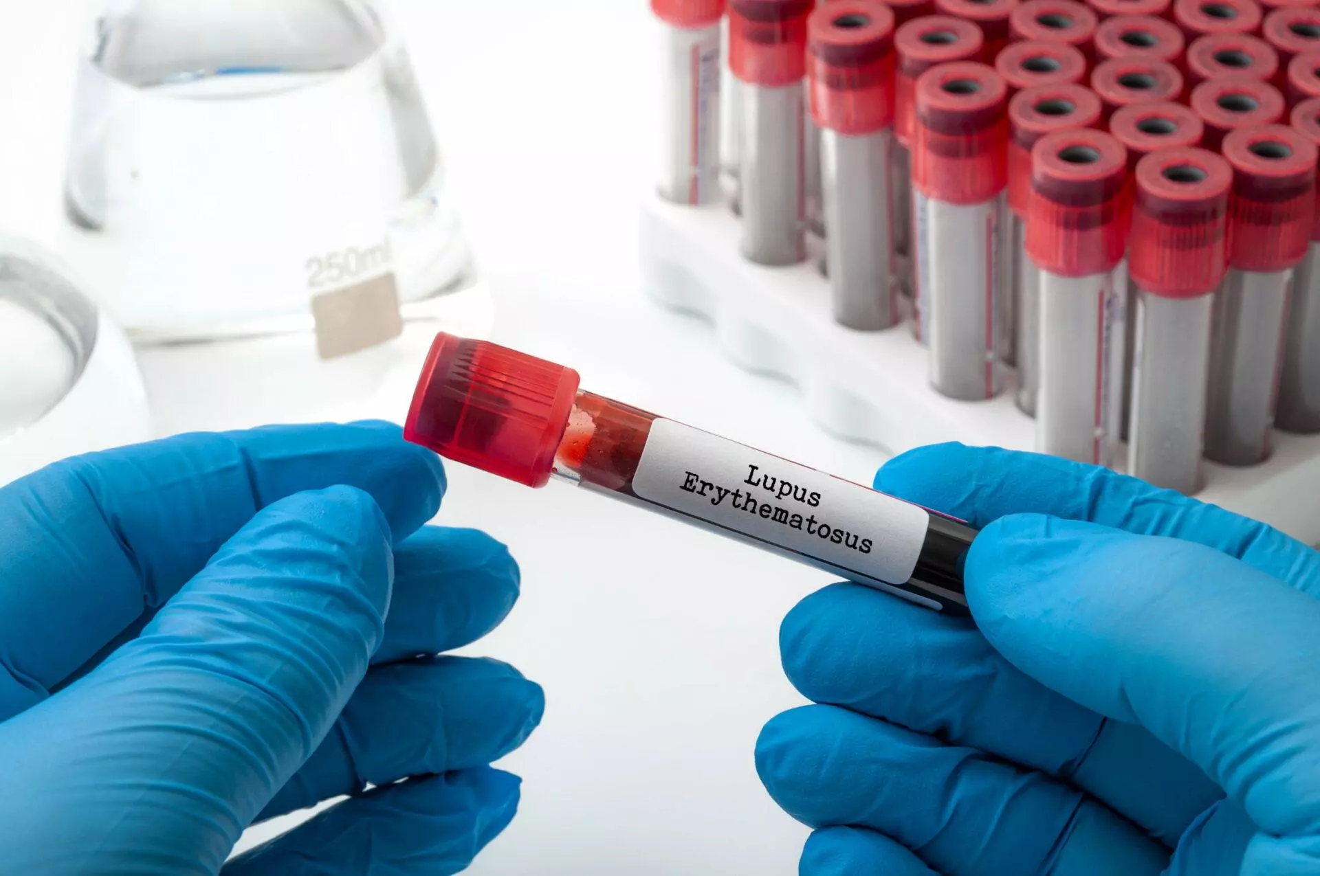 Doctor performing blood test on a medical sample while wearing blue latex protection gloves in lab and holding glass tube with the text lupus erythematosus