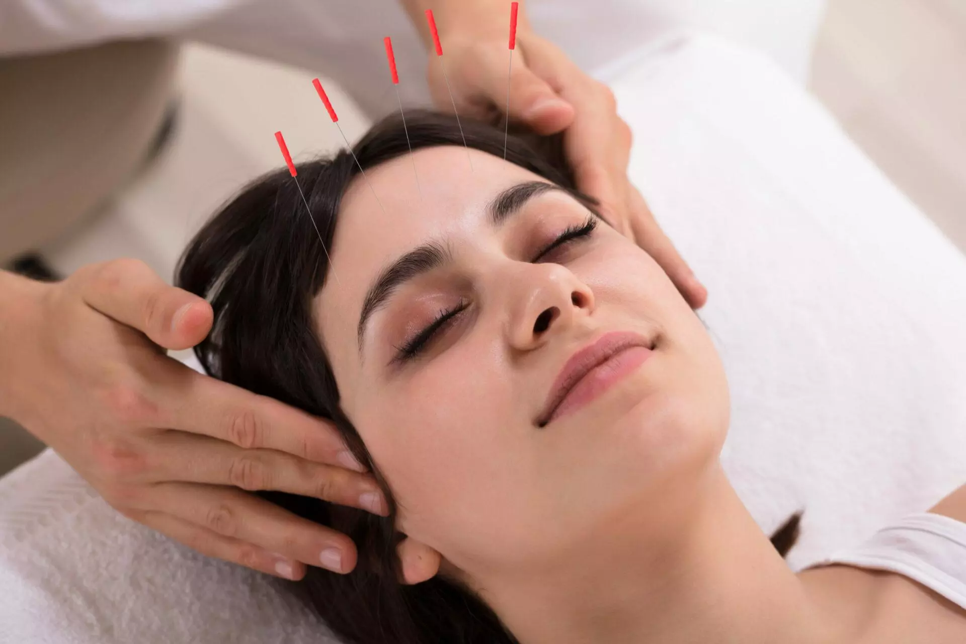 Woman receiving acupuncture on forehead