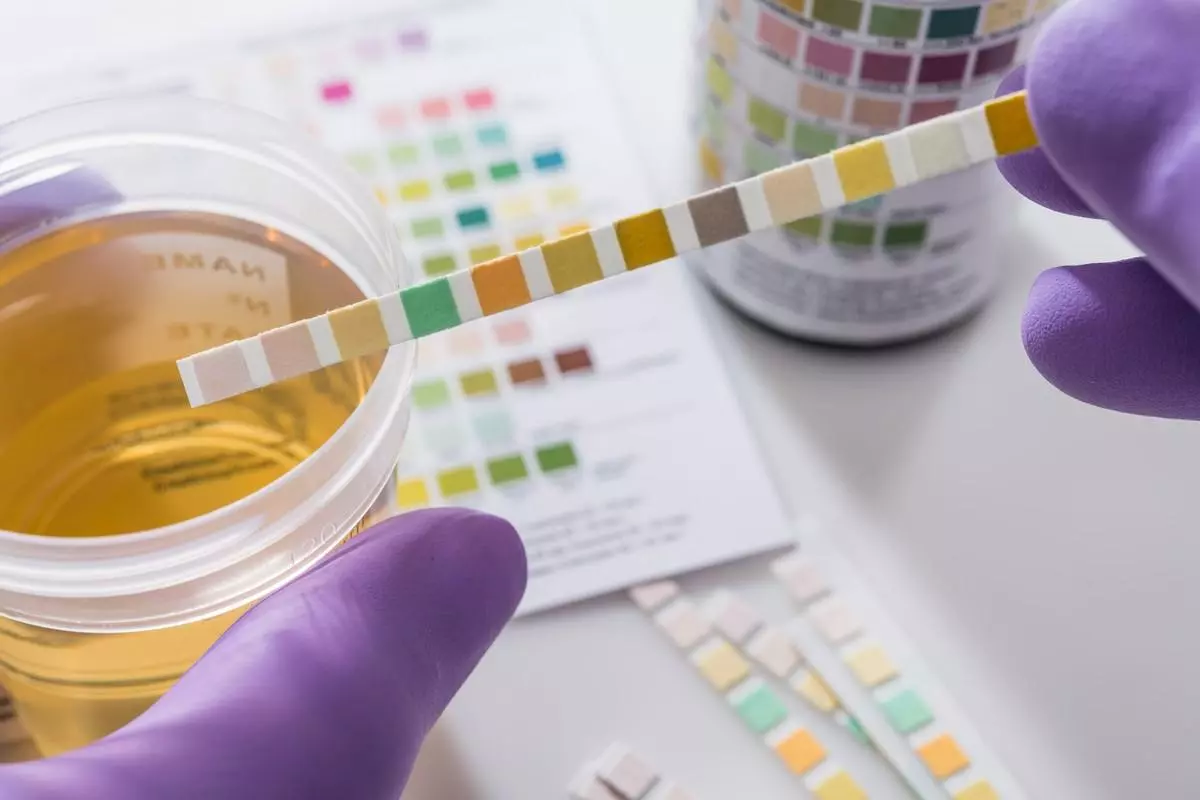 A urine specimen subjected to a colour-based litmus test.